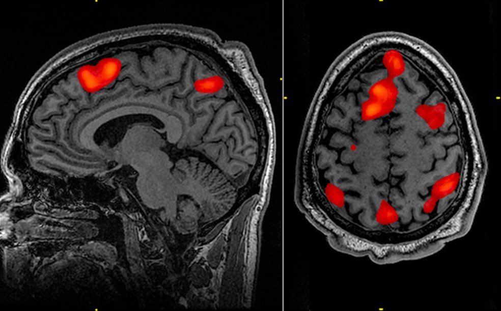 Estimativas indicam que o número de pessoas portadoras do gene da doença de Huntington no Brasil varia entre 13 e 19 mi. — Foto: Reprodução